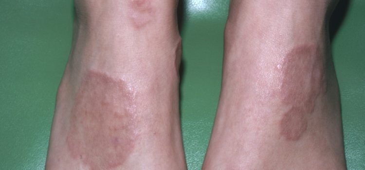 A 25-Year-Old Woman with Plaques on Her Elbows and Feet