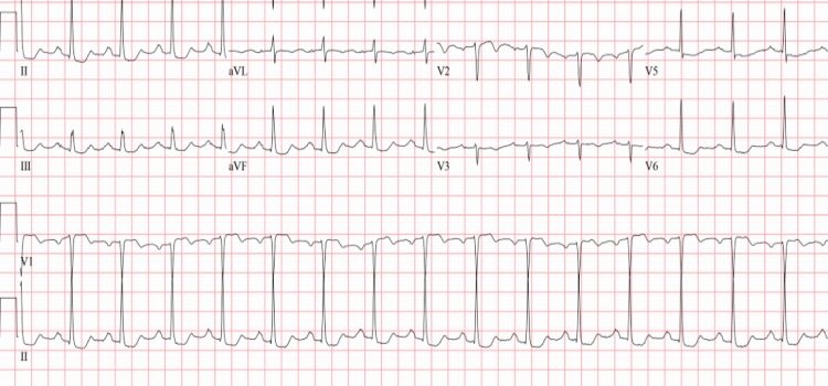 A 74-Year-Old Female with Multiple Episodes of Chest Pain Over a 2-Day Period