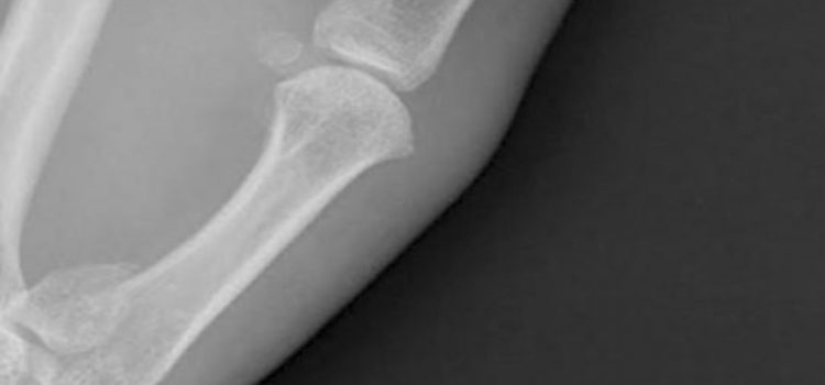 A 32-Year-Old Male with Thumb Pain After a Ski Fall