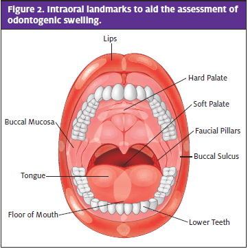 Odontogenic Infection; Assessment of Odontogenic swelling