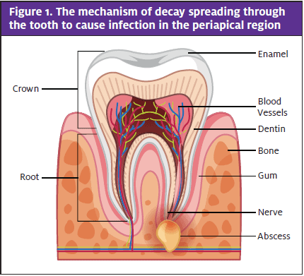 Odontogenic Infection; Tooth Region Labeled, Abscess