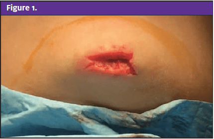 Chin Laceration in Pediatric Patient