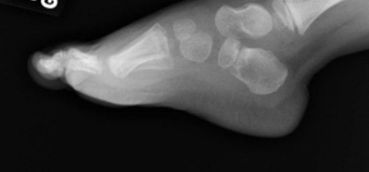 A 3-Year-Old Boy with Trouble Walking Due to Right Foot Pain