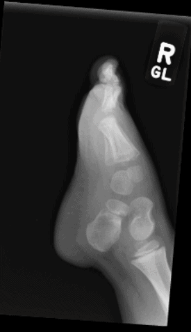 3-year old child's foot x-ray