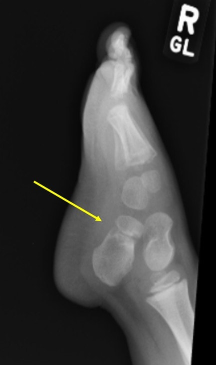 3-year old child's foot x-ray