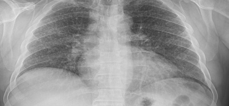 A 43-Year-Old Man with a Cough, Body Aches, and Fever