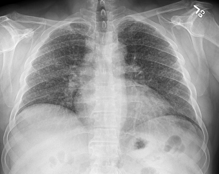 Miliary Lung XR