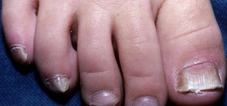 A 7-Year-Old Girl with White Patches on Her Toenails