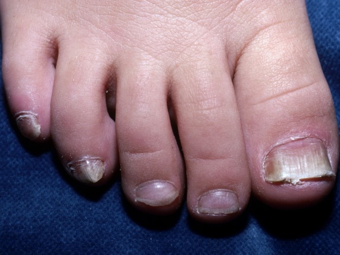 Pediatric Patient's Toenails with White Patches