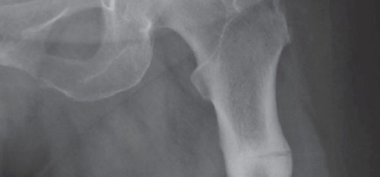 A 71-Year-Old Woman with Femur Pain After a Fall
