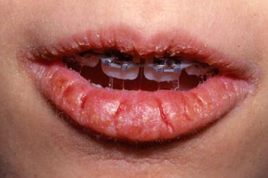 A 13-Year-Old Girl with Scaling and Fissures on Her Lips