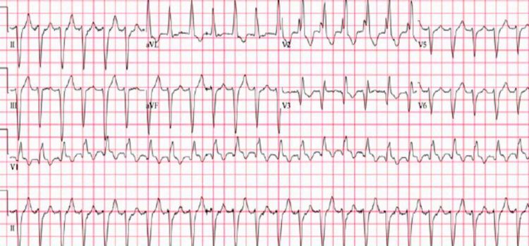 A 96-Year-Old Male with Palpitations and a History of CAD