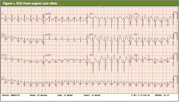 ECG From Urgent Care Clinic of someone that presented.  Atypical Presentation of Thyroid Storm
