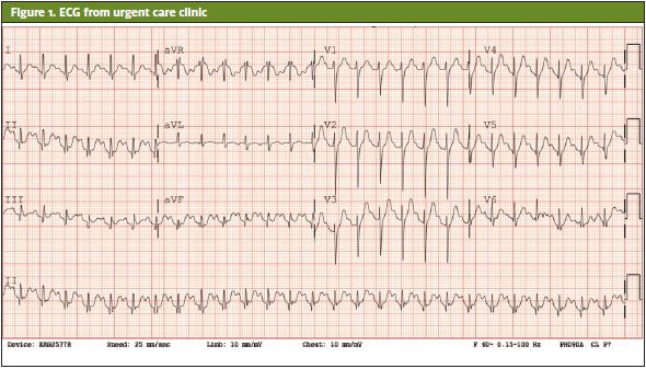 ECG From Urgent Care Clinic of someone that presented. Atypical Presentation of Thyroid Storm