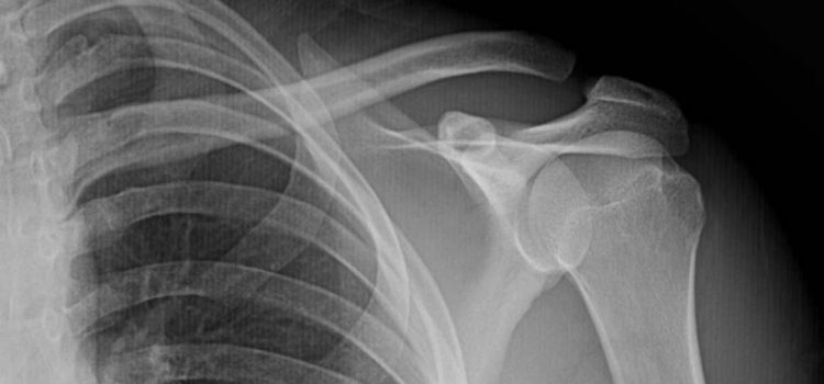 A 35-Year-Old Male with Shoulder Pain After a Fall