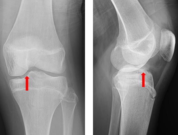 13 year old boy's x-ray image presenting with knee pain after a fall resolution