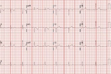 A 34-Year-Old Female with a Syncopal Episode but No Remarkable History