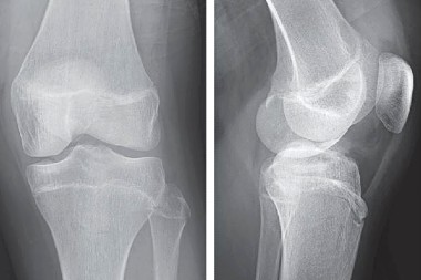 A 13-Year-Old Boy with Knee Pain After a Fall