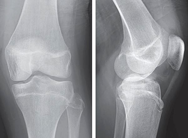 13 year old boy's x-ray image presenting with knee pain after a fall  initial image