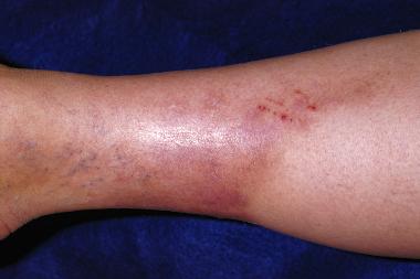 A 46-Year-Old Woman with a Painful, Erythematous Plaque on Her Leg