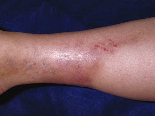 Derm Image of Lipodermatosclerosis