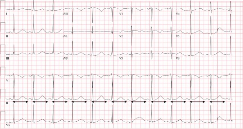 ECG 2