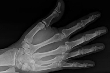 A 36-Year-Old Man with Wrist Pain After a Traumatic Impact