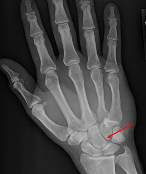 A 36-Year-Old Man with Wrist Pain After a Traumatic Impact xr resolution identifies with arrow