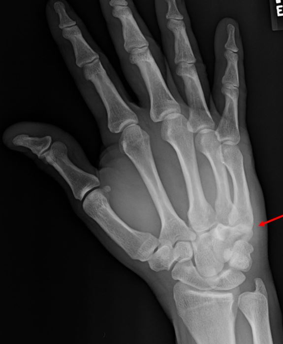 A 36-Year-Old Man with Wrist Pain After a Traumatic Impact xr 2 arrow identifying issue