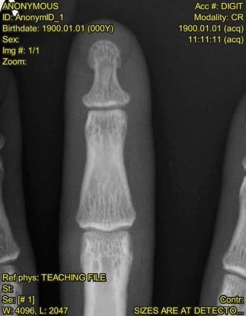 The patient is a 32-year-old man who presents with pain over the distal phalanx of the middle finger after dropping a 20-pound weight on his finger while constructing a home gym set-up. The skin is unbroken, but pain is evident upon palpation over the distal phalanx of the middle finger. Neurovascular status is intact. 	View the image taken (Figure 1) and consider what your diagnosis and next steps would be. Resolution of the case is described on the next page.