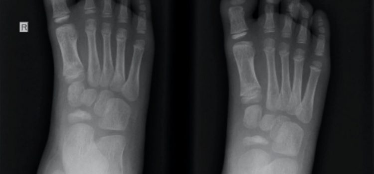 A 5-Year-Old with Foot Pain of Unknown Origin