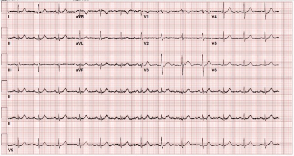 ECG of patient