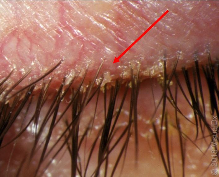 Eye pain and burning image of eye lash line closeup