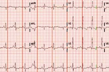 A 38-Year-Old Female with Abdominal Pain and Chest Tightness