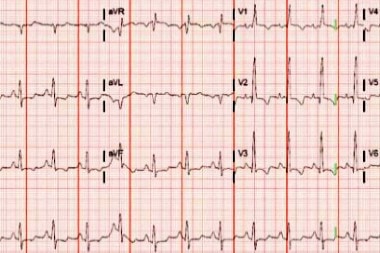 A 38-Year-Old Female with Abdominal Pain and Chest Tightness