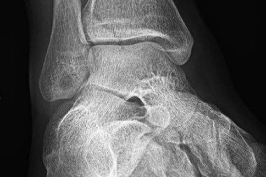 A 24-Year-Old Man with Ankle Pain After a Fall