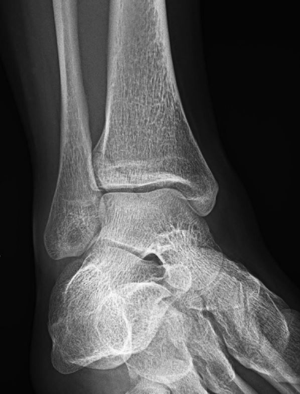 X-ray image 1 of the 24-year-old with pain after a fall