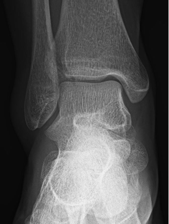 X-ray image 2 of the 24-year-old with pain after a fall