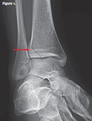 X-ray image 1 of the 24-year-old with pain after a fall- the resolution identified.  