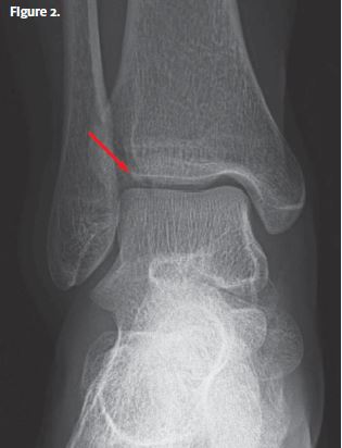 X-ray image 2 of the 24-year-old with pain after a fall- the resolution identified.  