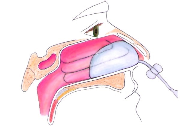 Anterior Packing 