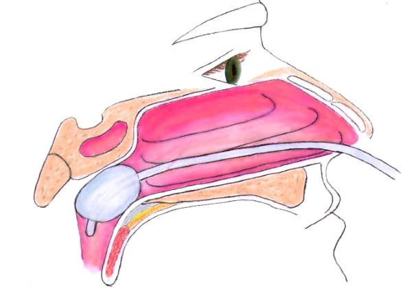 Posterior Packing