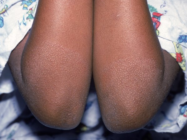 Image of child with scaly papules
