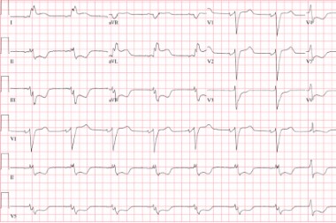 A 70-Year-Old Female with Nonradiating Chest Pain