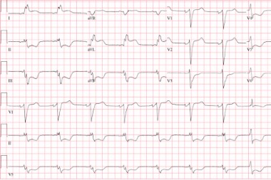 A 70-Year-Old Female with Nonradiating Chest Pain