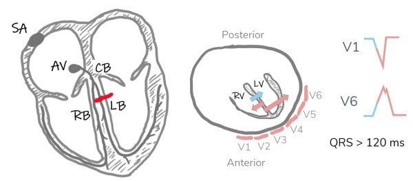 Depolarization in left bundle branch block