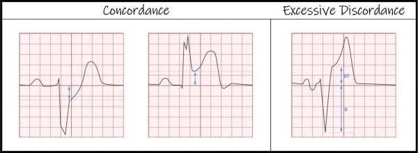 Sgarbossa criteria