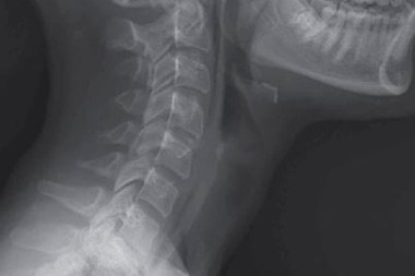 Neck Pain in a 17-Year-Old