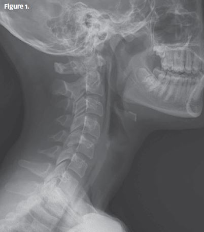 x-ray of neck