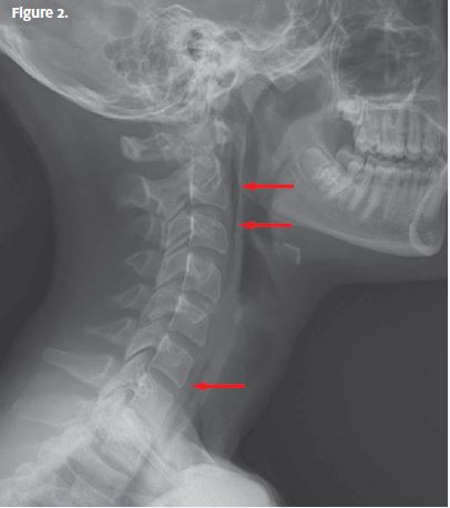 X-ray of neck with arrows indicating issue